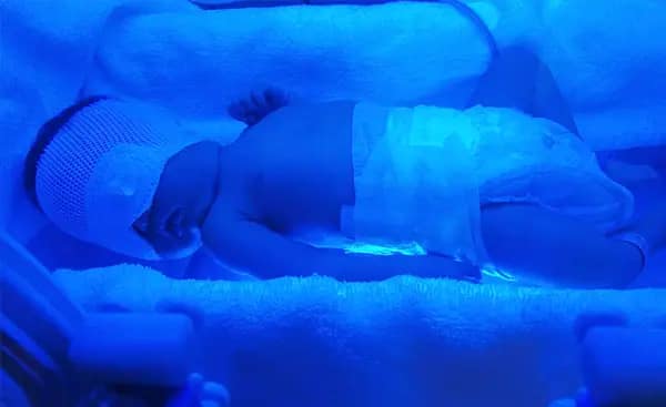 Newborns undergoing blue light phototherapy to reduce jaundice