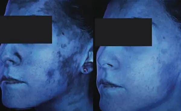Light therapy for skin diseases